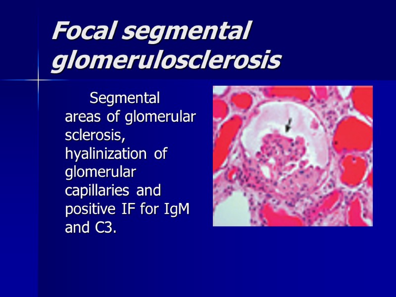 Focal segmental glomerulosclerosis    Segmental areas of glomerular sclerosis, hyalinization of glomerular